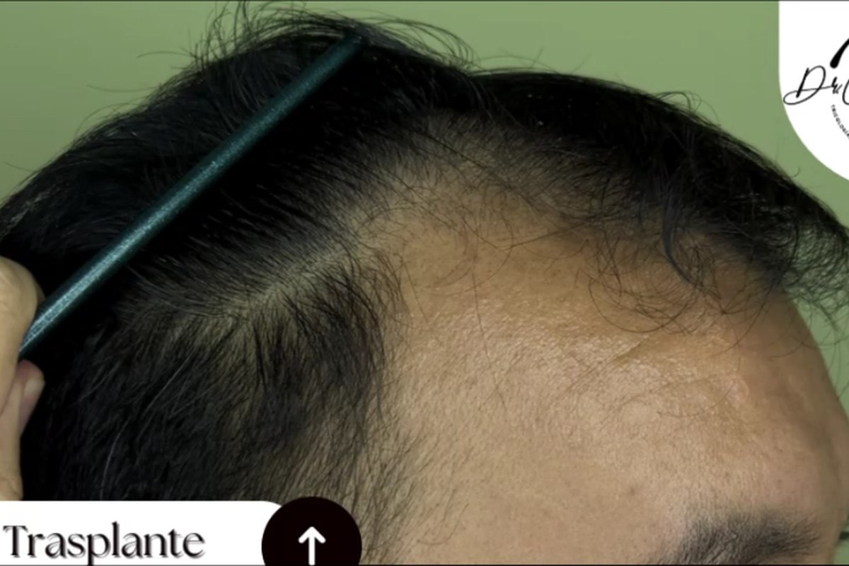 Antes trasplante capilar — diseño personalizado