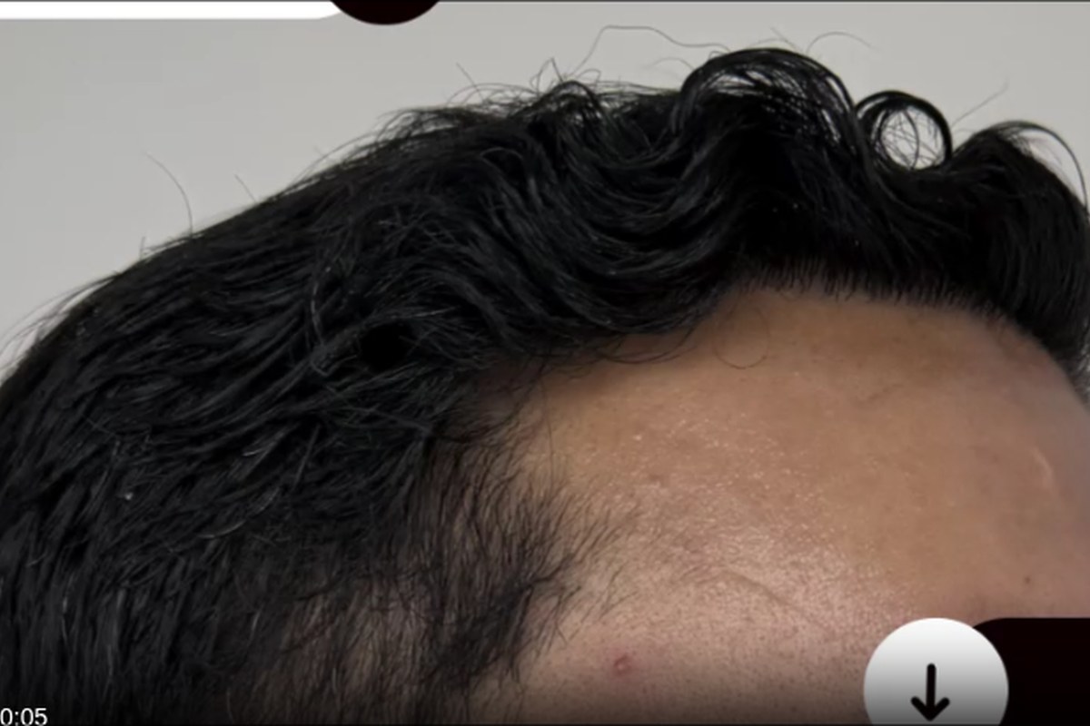 Después trasplante capilar — diseño personalizado