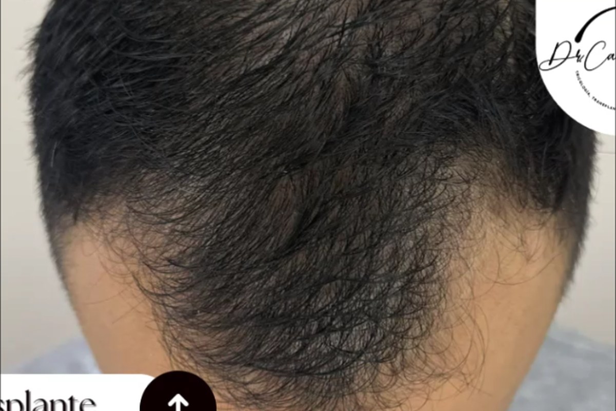 Antes trasplante capilar — zona frontal