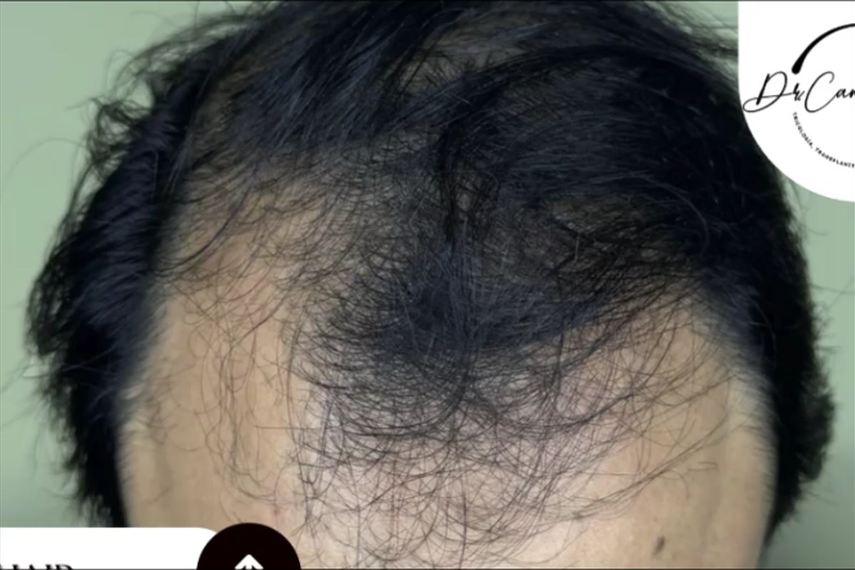 Antes trasplante capilar — 8 meses