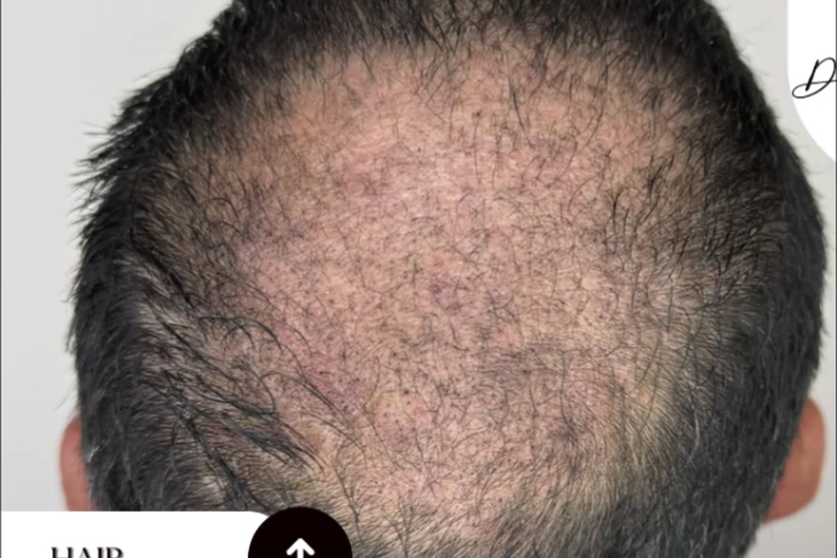 Antes trasplante capilar — corona y frontal