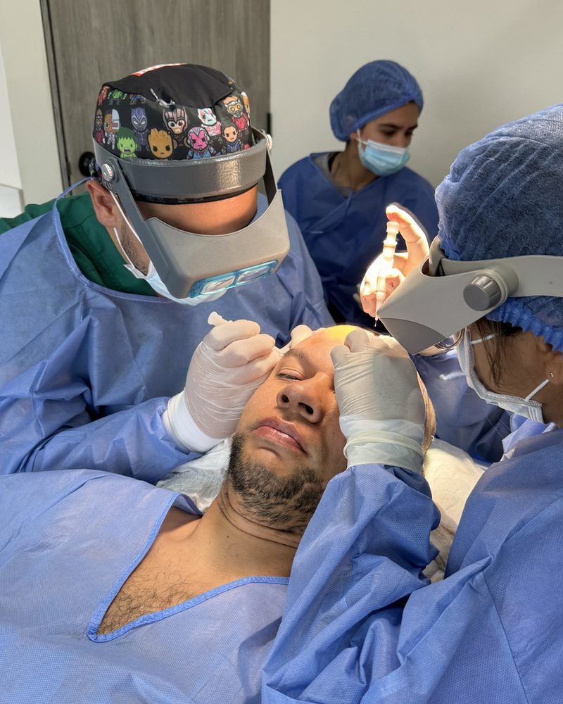 Trasplante de barba